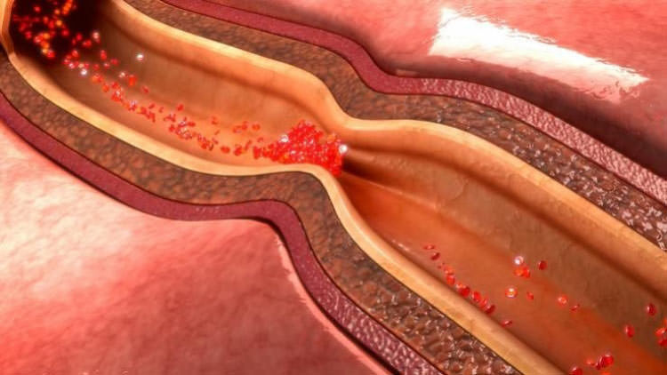 Arteriosklerose