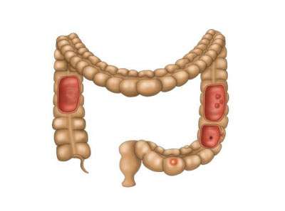 Colitis Ulcerosa: Chronisch-entzündliche Darmerkrankungen