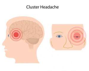 Cluster-Kopfschmerz: Symptome