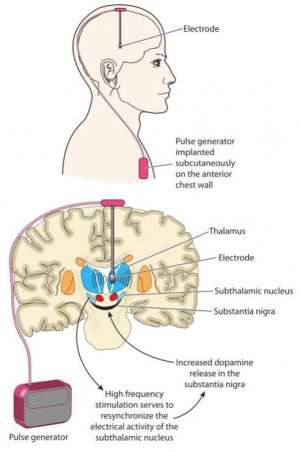 Cluster-Kopfschmerz: Besserung durch Hirnschrittmacher