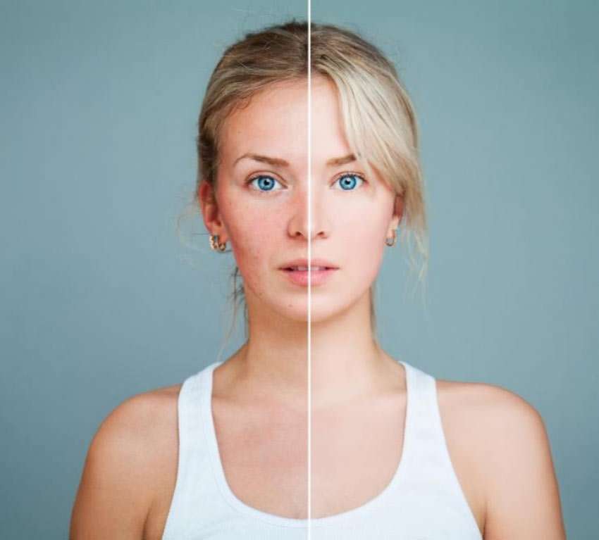 Rosacea 